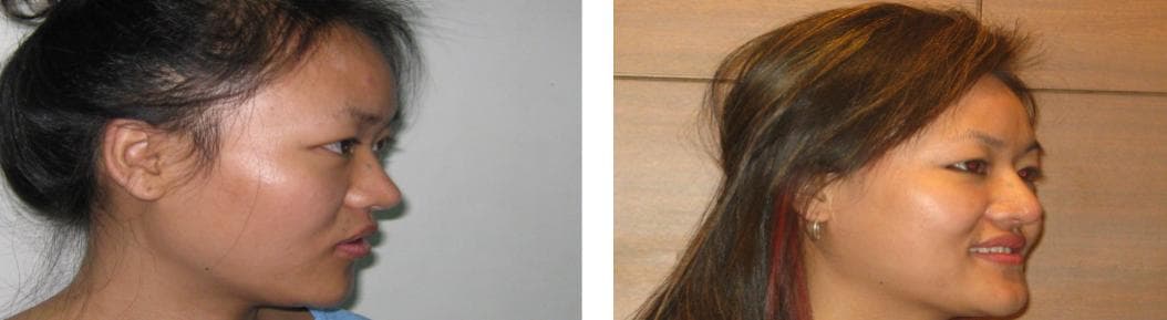 Rhinoplasty 1.jpg