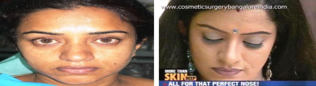 Rhinoplasty 3.jpg