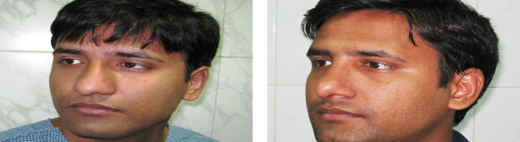 Rhinoplasty10.jpg