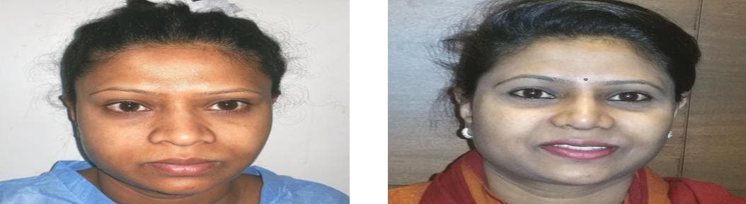 Rhinoplasty11.jpg