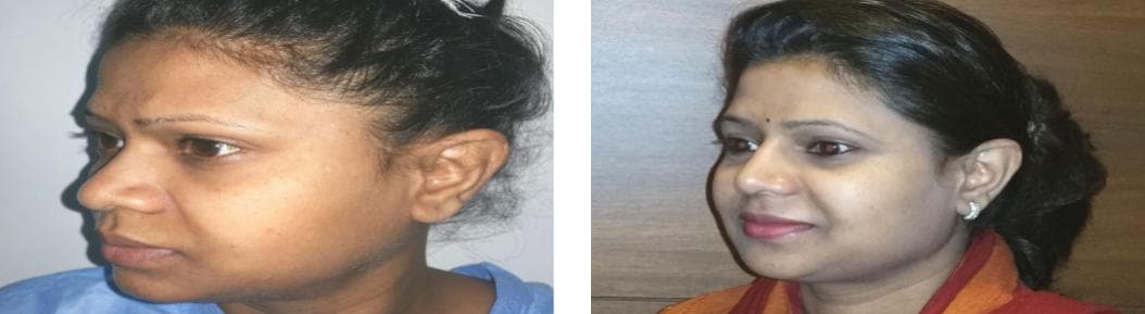 Rhinoplasty12.jpg