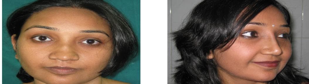Rhinoplasty14.jpg