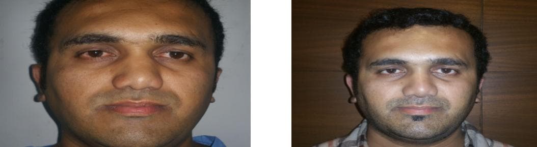 Rhinoplasty15.jpg