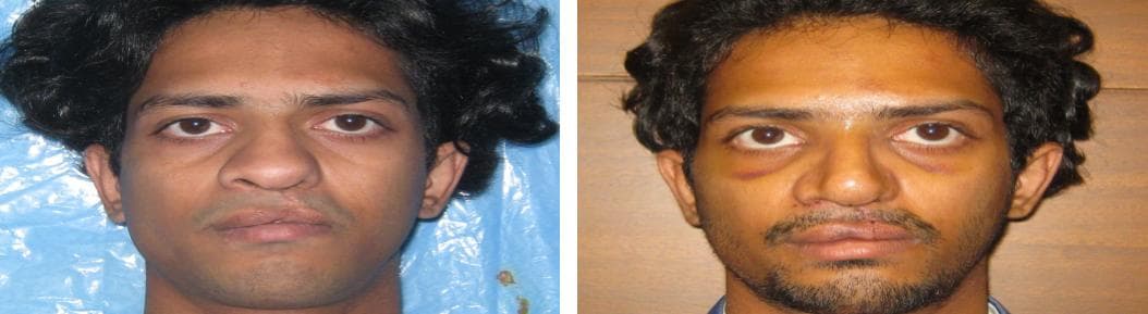 Rhinoplasty16.jpg