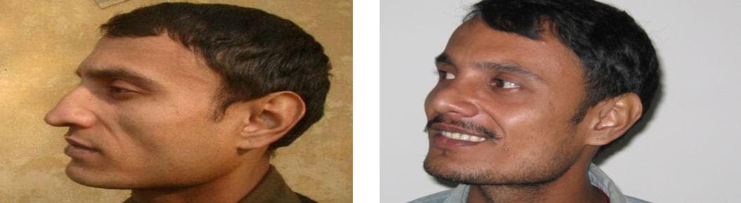 Rhinoplasty18.jpg