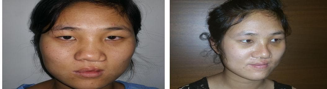 Rhinoplasty19.jpg