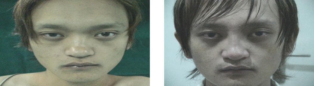 Rhinoplasty2.jpg