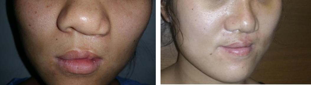 Rhinoplasty21.jpg