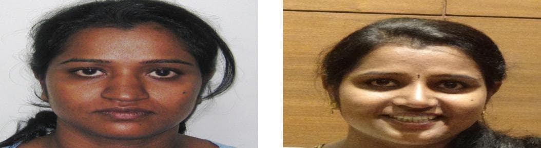 Rhinoplasty22.jpg