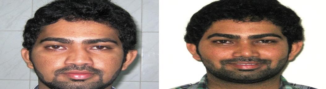 Rhinoplasty23.jpg