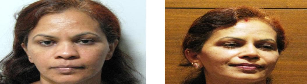 Rhinoplasty24.jpg