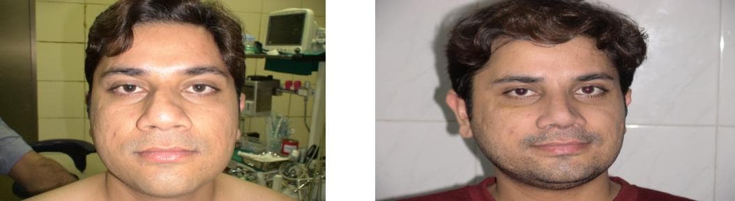 Rhinoplasty25.jpg