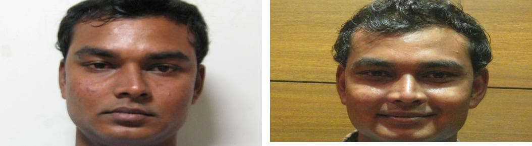 Rhinoplasty26.jpg