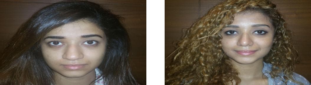 Rhinoplasty27.jpg