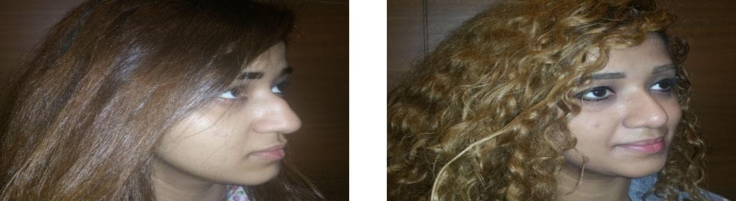Rhinoplasty28.jpg
