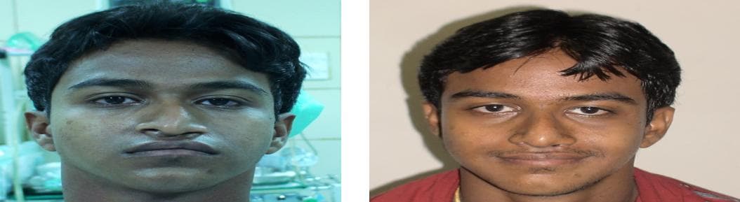 Rhinoplasty4.jpg