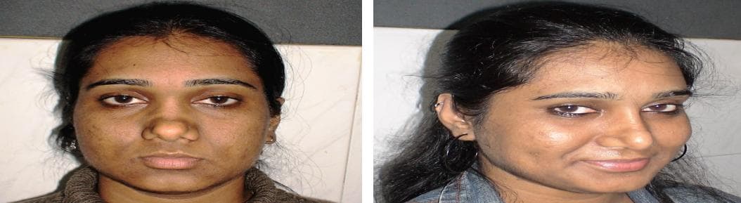 Rhinoplasty6.jpg