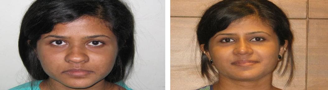 Rhinoplasty7.jpg