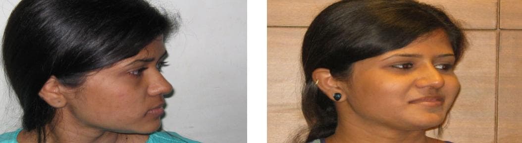 Rhinoplasty8.jpg