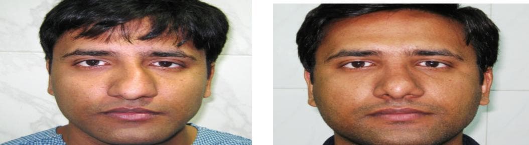 Rhinoplasty9.jpg